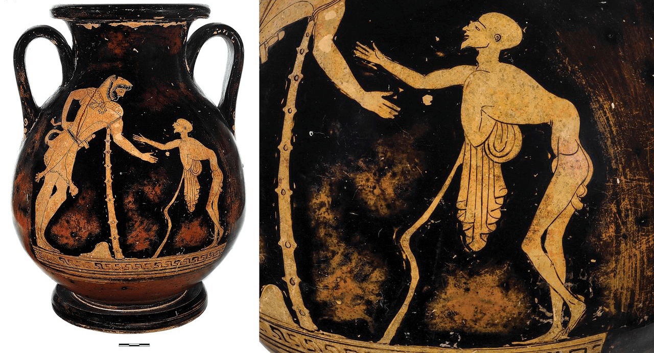 Греческая амфора 5 века до н.э.Слева Геракл.Справа — бог старости Герас на рисунке запечатлен с деформированным позвоночником и атрофированными мышцами — характерными признаками полиомиелита.