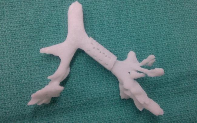 Напечатанный на 3D принтере расширитель трахеи спас жизнь ребенку