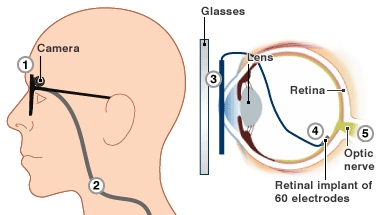 Argus II Retinal Prosthesis System были впервые имплантированы