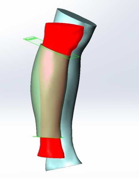 Косметический протез икроножной мышцы, напечатанный на 3D принтере