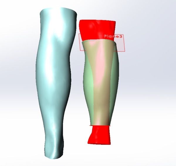 Косметический протез икроножной мышцы, напечатанный на 3D принтере