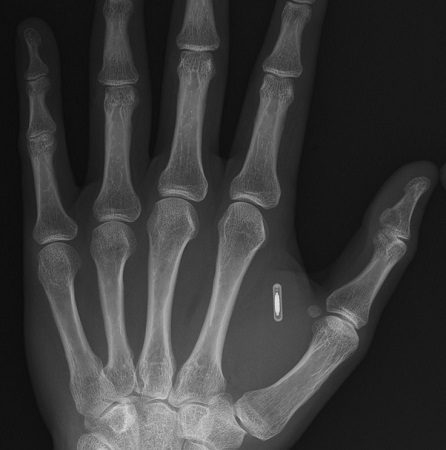 Как я имплантировал RFID себе в руку, а потом еще NFC. Часть 1 - 1