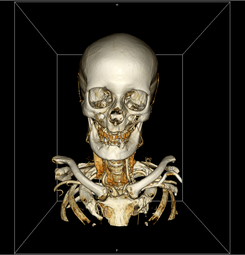 DICOM Viewer изнутри. Воксельный рендер - 10