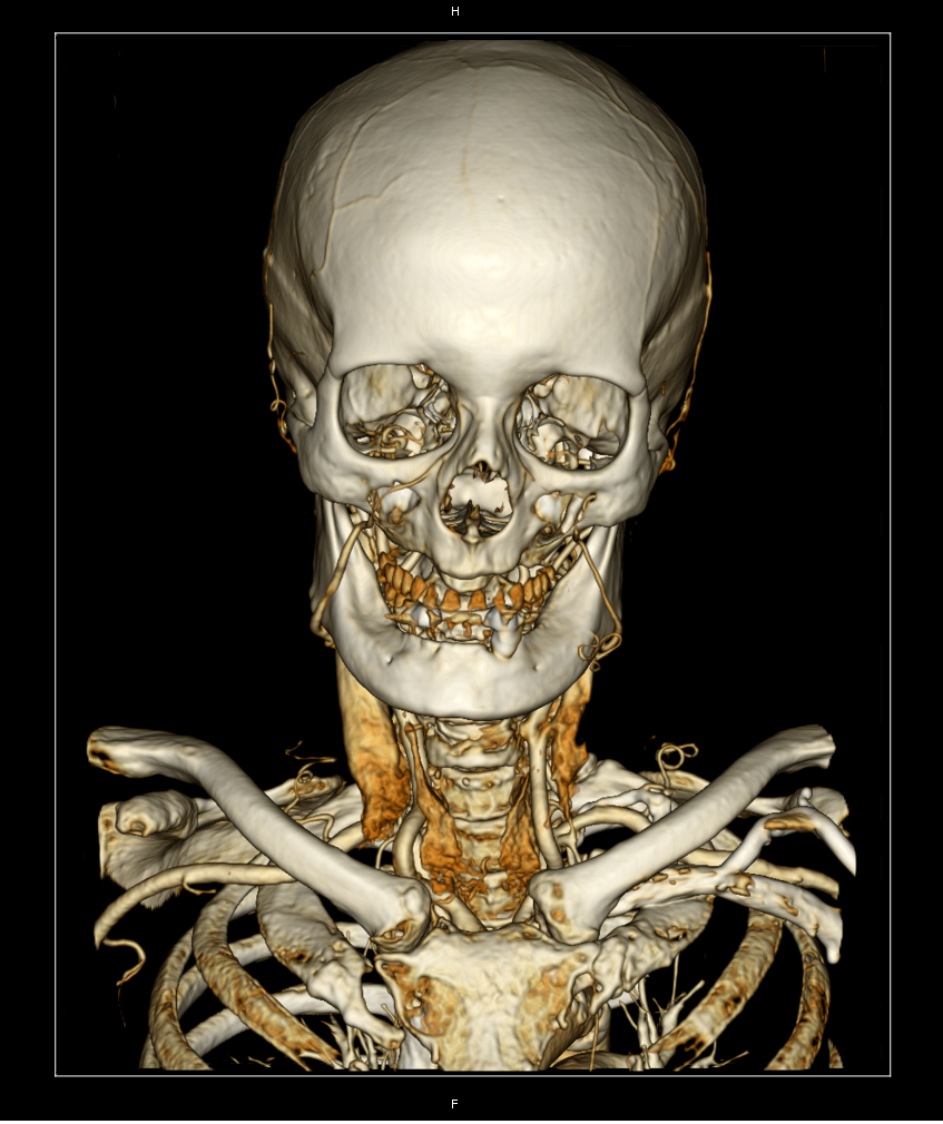 DICOM Viewer изнутри. Воксельный рендер - 11