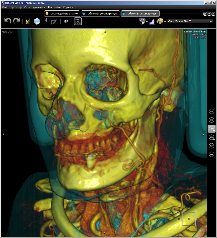 DICOM Viewer изнутри. Воксельный рендер - 7