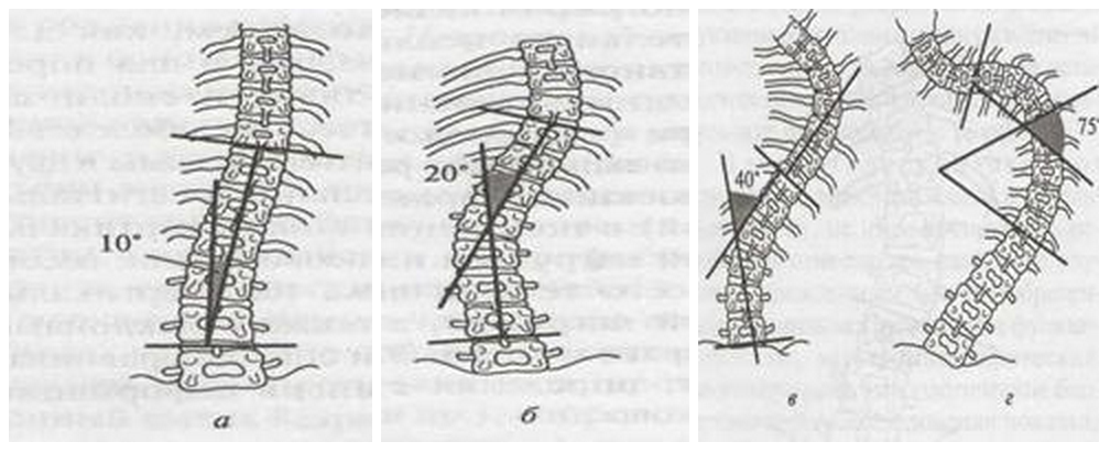 Искривление позвоночника градусы. Сколиоз угол искривления 17 градусов. S образный сколиоз 1 степени по чаклину. Сколиоз позвоночника 2 степени угол искривления. Сколиоз 2 степени угол искривления 17.
