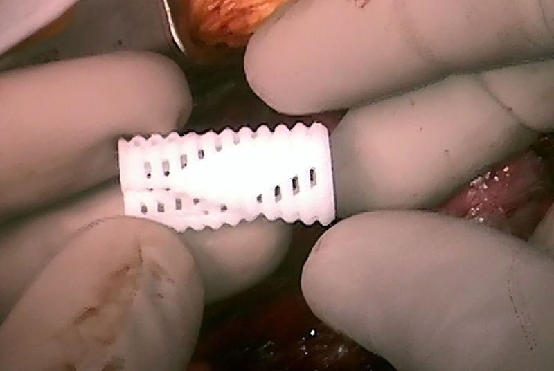Отпечатанный на 3D принтере участок трахеи спасает жизни детям - 1