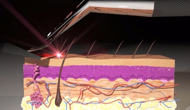 Новый способ борьбы со щетиной - 6 Новый способ борьбы со щетиной - 6