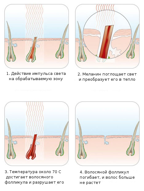 Лазерная бритва Skarp: недалекое будущее или очередной обман? - 2