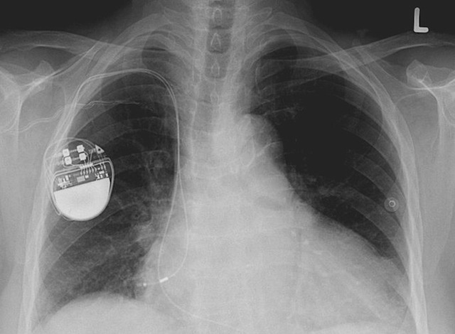 Можно ли взломать кардиостимулятор: краткая история безопасности медицинских устройств - 4