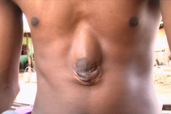 В Индии 18-летний парень с сердцем наружу борется за жизнь. ФОТО - 1 1