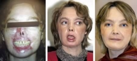 Самая сложная за всю историю операция по полной пересадке лица завершилась успешно - 10 image