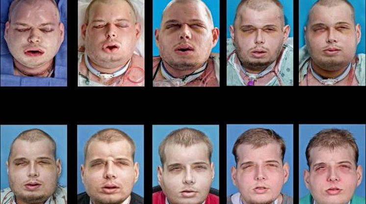 Самая сложная за всю историю операция по полной пересадке лица завершилась успешно - 5 Самая сложная за всю историю операция по полной пересадке лица завершилась успешно - 5