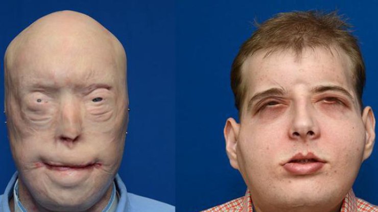 Самая сложная за всю историю операция по полной пересадке лица завершилась успешно - 6 image