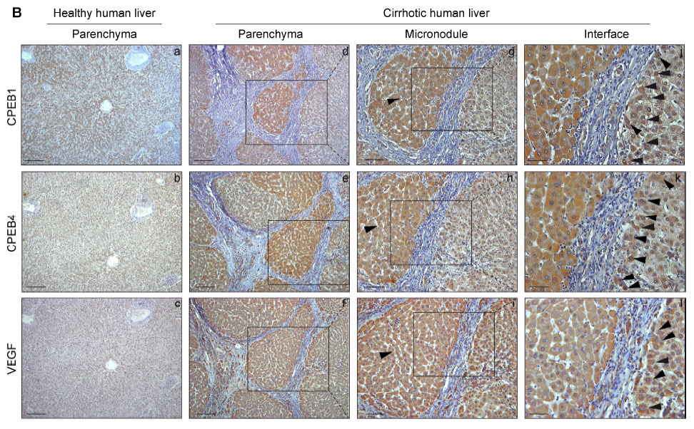 Найдено потенциальное лекарство от цирроза печени - 2 Найдено потенциальное лекарство от цирроза печени - 2