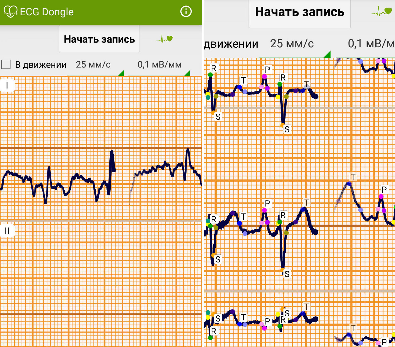 ЭКГ на дому, или сделано в России: отечественные разработчики представили кардиофлешку - 7