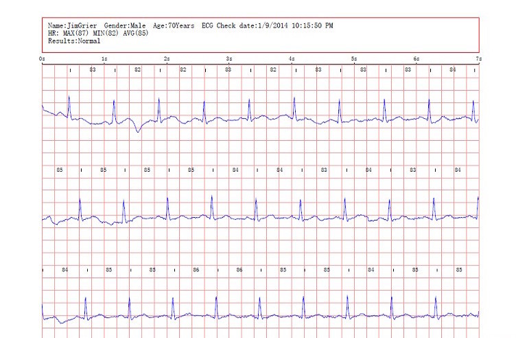 ЭКГ на дому: подборка портативных аппаратов - 10