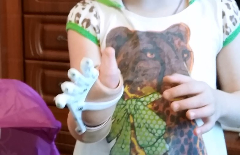 Как «Моторика» делает протезы для детей - 11 Как «Моторика» делает протезы для детей - 11