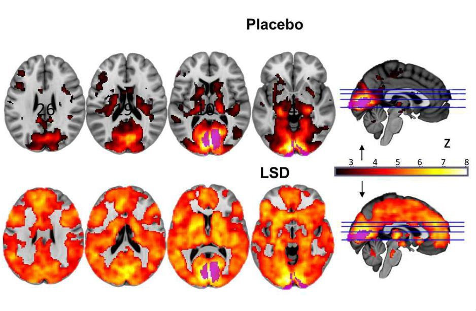 Сканы мозга показали, как ЛСД действует на сознание - 2