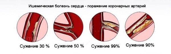 Медицинские гаджеты для смартфонов помогут в борьбе с ишемической болезнью сердца - 3