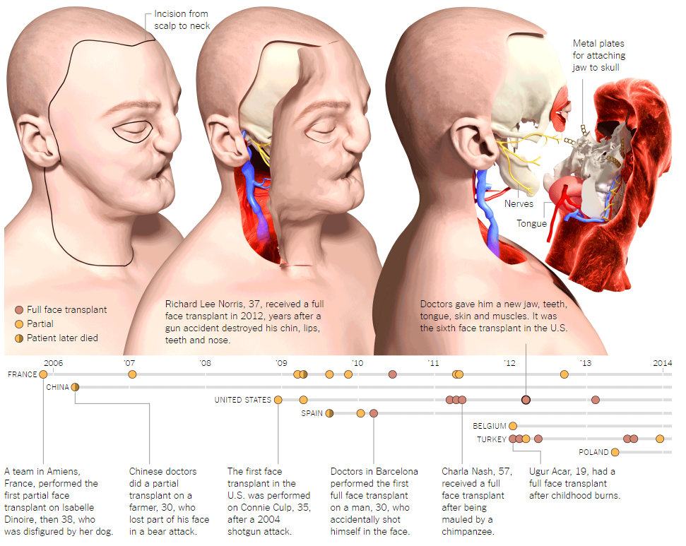 Умерла первая женщина, которой частично пересадили лицо - 4