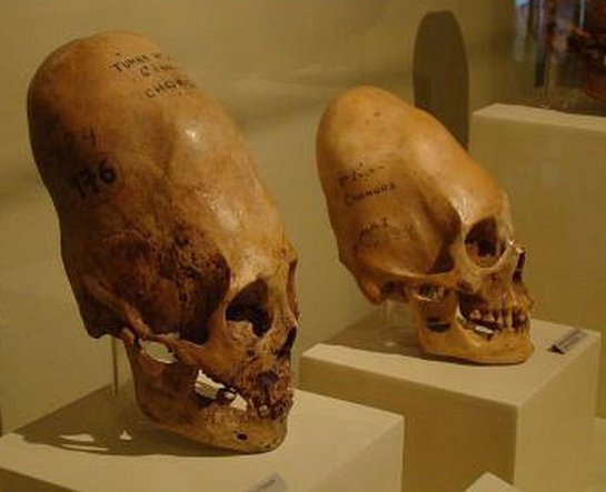 В Баксанском ущелье нашли черепа людей с вытянутыми головами