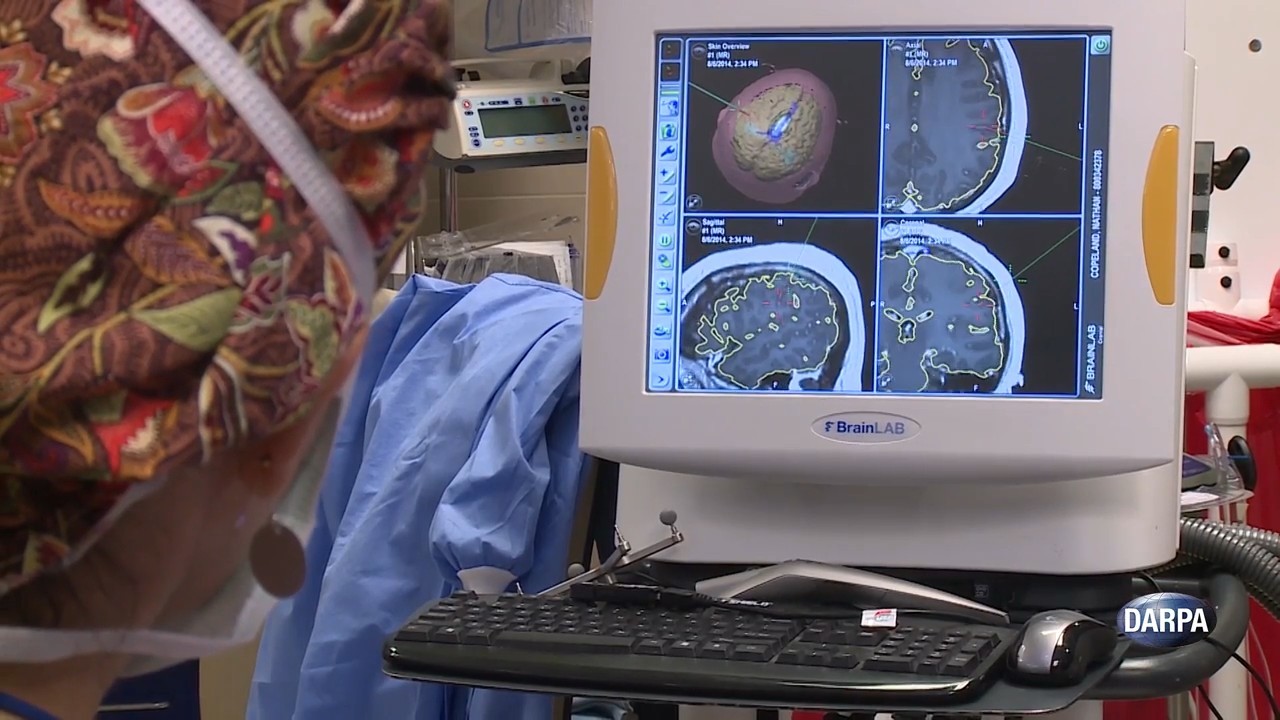 Создан человеческий мозговой имплантат для получения тактильных ощущений от механической руки - 3 Создан человеческий мозговой имплантат для получения тактильных ощущений от механической руки - 3