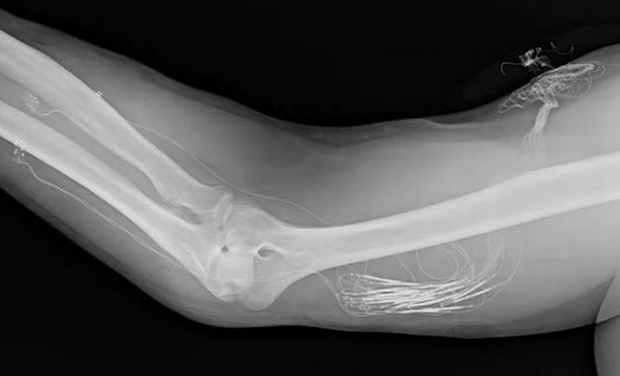 Создан человеческий мозговой имплантат для получения тактильных ощущений от механической руки - 6 Создан человеческий мозговой имплантат для получения тактильных ощущений от механической руки - 6