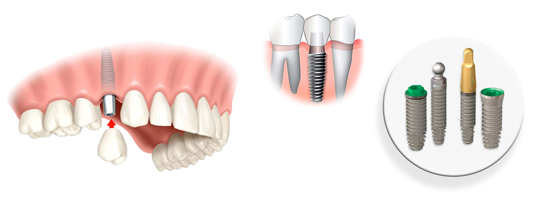 Ученые выяснили, какие лекарства не стоит пить перед имплантацией зубов - 3