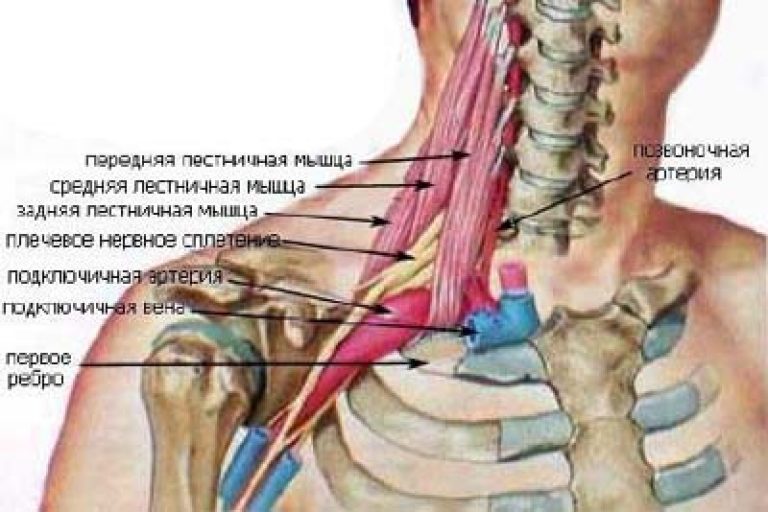 синдром передней лестничной мышцы