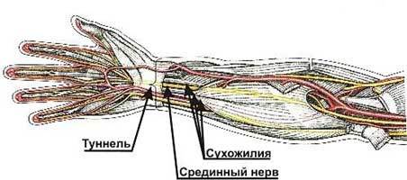 синдром запястного канала