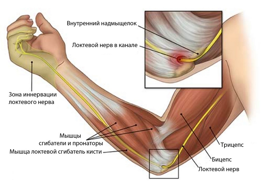 синдром локтевого канала