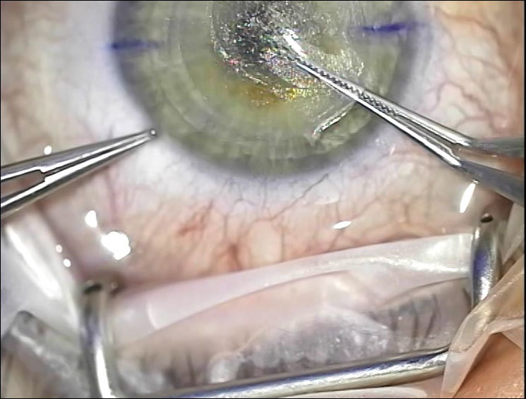 Лазер, который режет внутри роговицы: процедура ReLEх на физическом уровне - 9 Лазер, который режет внутри роговицы: процедура ReLEх на физическом уровне - 9