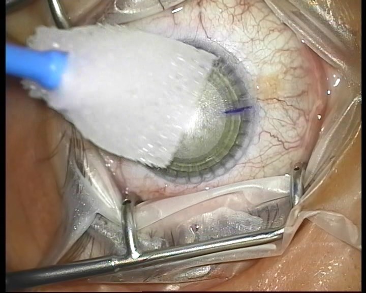 Телеметрия с лазера для коррекции зрения: полная операция с комментариями (не для слабонервных) - 12