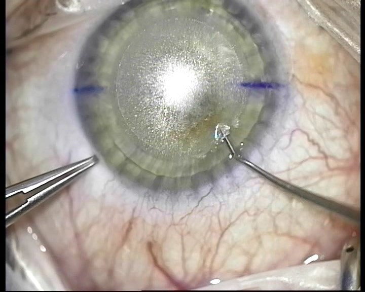 Телеметрия с лазера для коррекции зрения: полная операция с комментариями (не для слабонервных) - 15