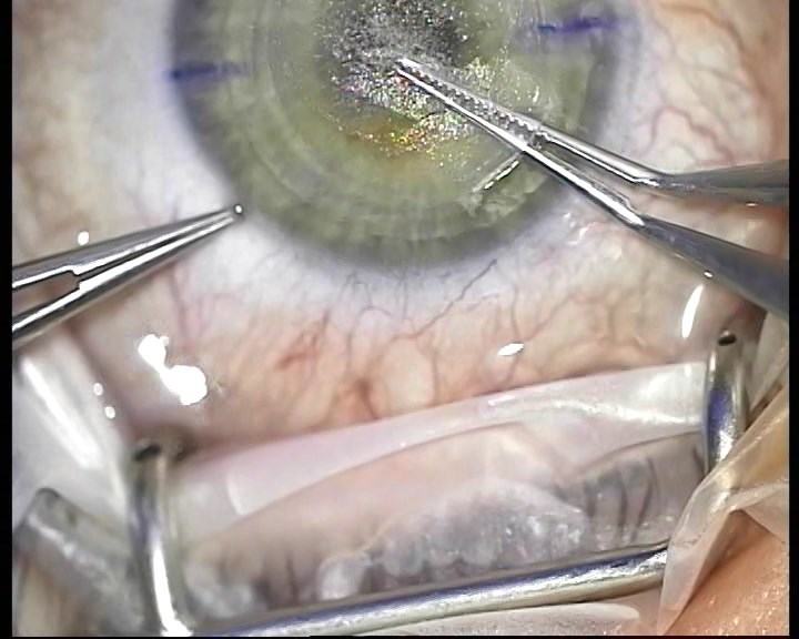 Телеметрия с лазера для коррекции зрения: полная операция с комментариями (не для слабонервных) - 17