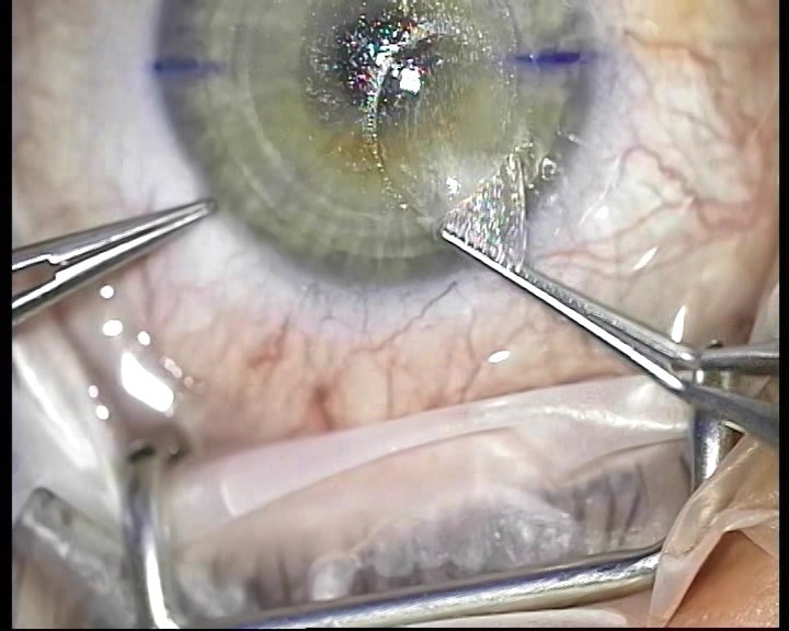 Телеметрия с лазера для коррекции зрения: полная операция с комментариями (не для слабонервных) - 18