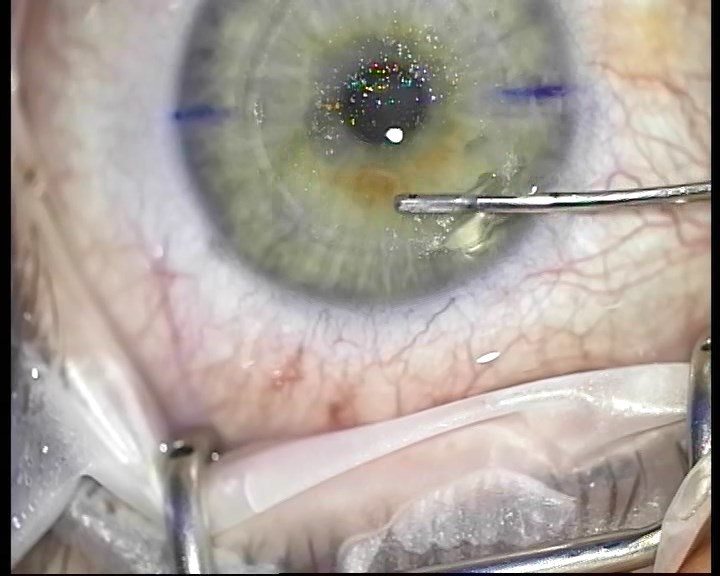 Телеметрия с лазера для коррекции зрения: полная операция с комментариями (не для слабонервных) - 21