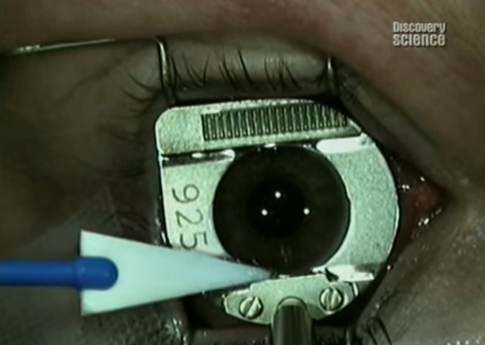 История операций по коррекции зрения: сравнение рисков и побочных эффектов - 1