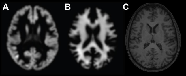 Нейросеть научилась определять возраст мозга по МРТ - 2 image