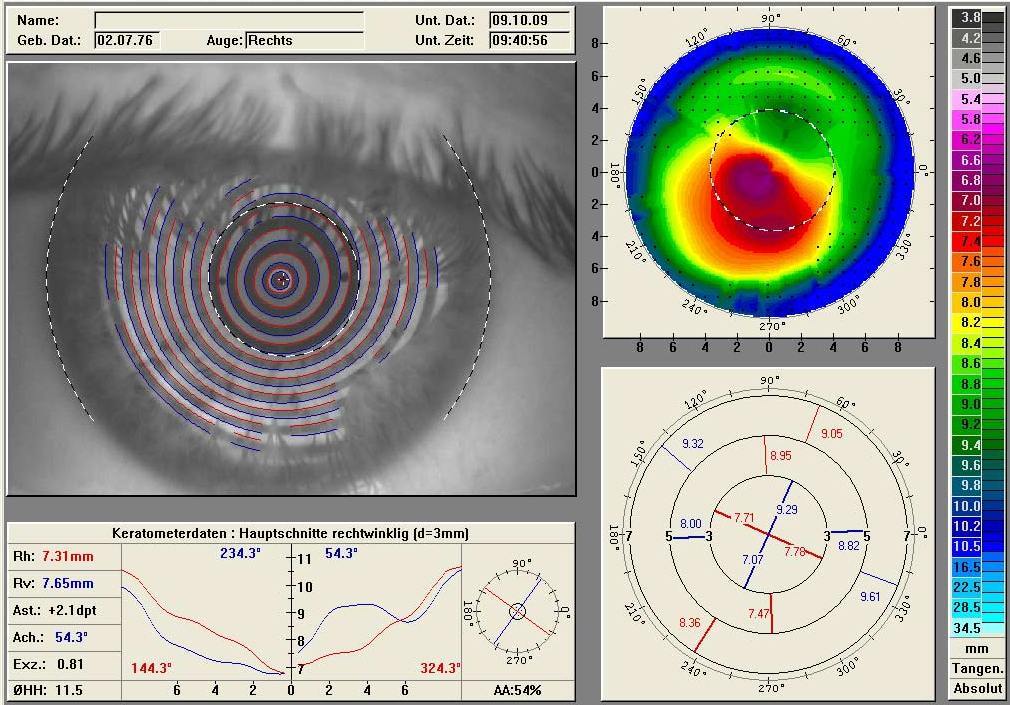 Мы добрались до побочных эффектов лазерной коррекции зрения — и ещё до диагностики - 1
