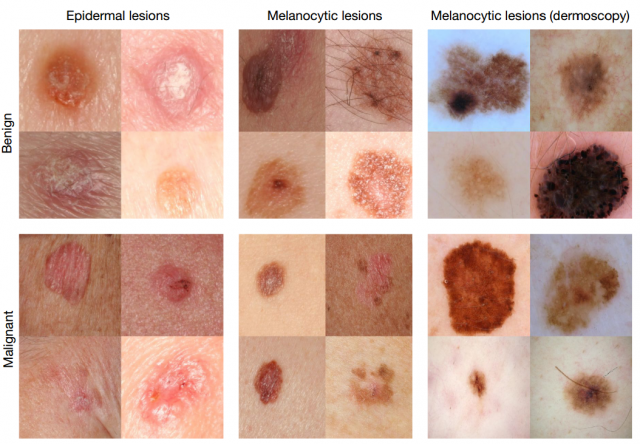 Алгоритм глубинного обучения диагностирует рак кожи не хуже квалифицированного дерматолога - 2