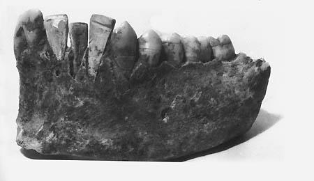 История имплантируемой техники. Зубные протезы - 3 image