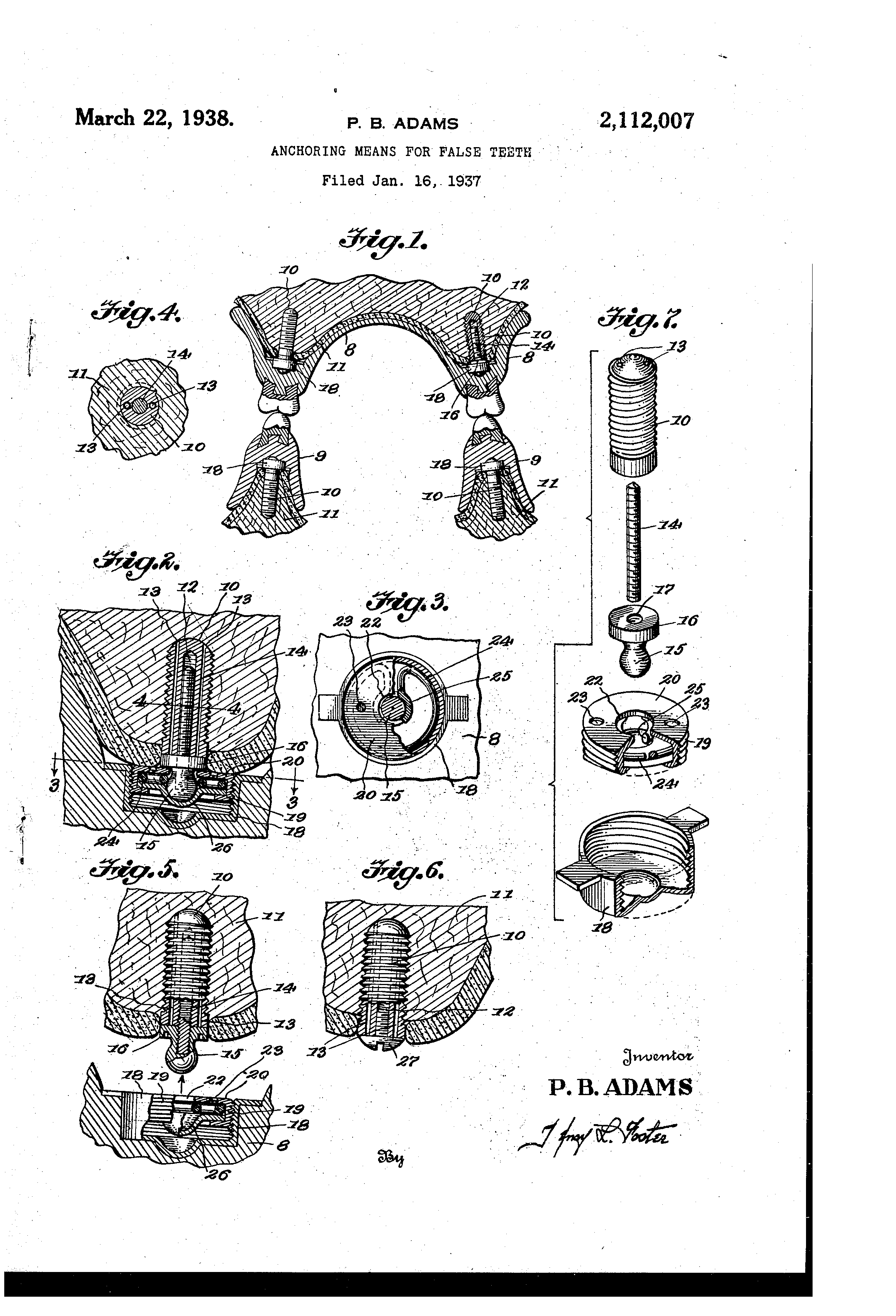 История имплантируемой техники. Зубные протезы - 5 image