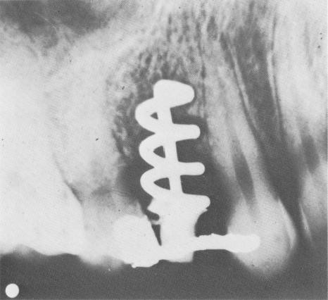 История имплантируемой техники. Зубные протезы - 6 image