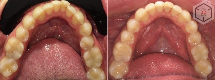 Как мы тестировали исправление прикуса элайнерами на нашем директоре - 36