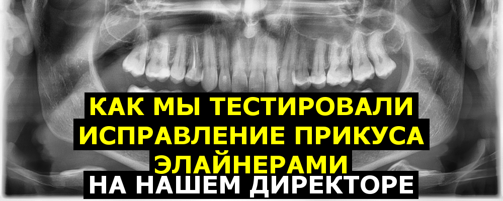 Как мы тестировали исправление прикуса элайнерами на нашем директоре - 1