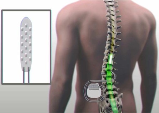 В США парализованный задвигал ногами после электрической стимуляции спинного мозга - 3
