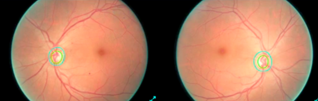 Глубокое обучение и нейронные сети позволяют идентифицировать диабетическую ретинопатию с точностью в 86% - 1