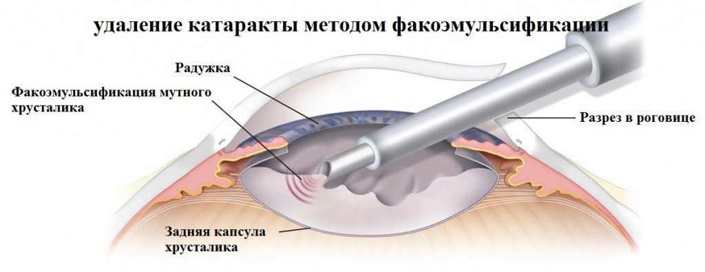 Имплантируем искусственный хрусталик (вам это понадобится лет после 60) - 2